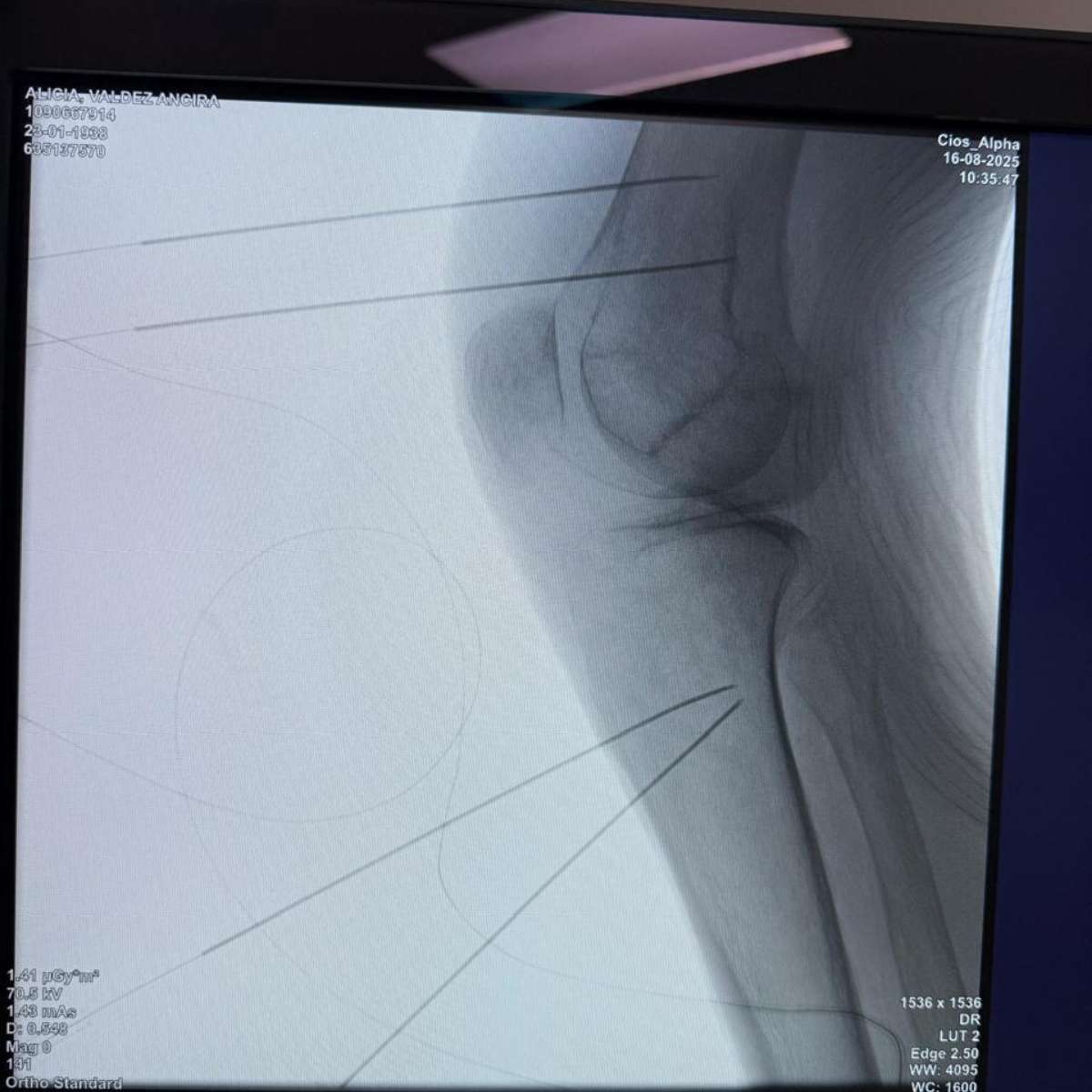 tratamiento-para-dolor-de-rodilla-yolanda-ramirez-a